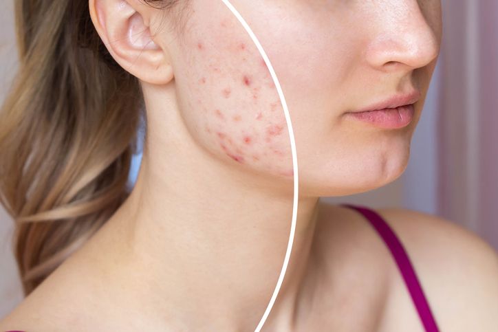 Unlock Clear Skin: Discover Effective Acne Solutions in Modbury, Adelaide